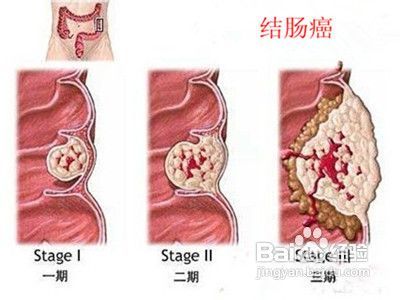 4949正版免費(fèi)資料大全，腸炎的最佳治療指南，4949正版免費(fèi)資料與腸炎最佳治療指南的綜合資源集合